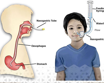 استفاده از لوله تغذیه بینی به معده (NG tube) برای افرادی که نیاز به کمک تغذیه‌ای دارند، می‌تواند در خانه با حضور پرستار منزلی انجام شود.
