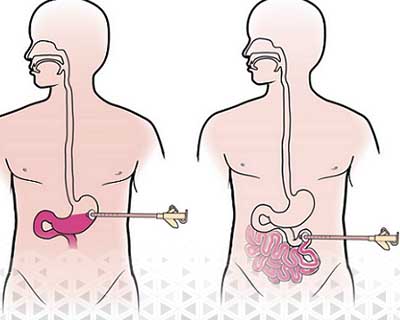 زمان تعویض پگ معده معمولاً بسته به نوع لوله و شرایط بیمار، هر 6 تا 12 ماه یک‌بار توصیه می‌شود تا از کارایی مناسب آن اطمینان حاصل شود.